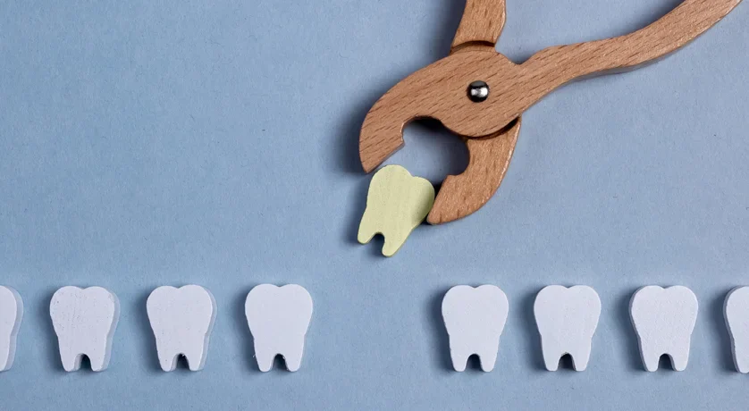 Tooth Extractions
