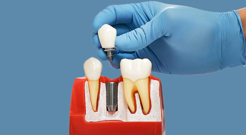 Dental Implants: The Most Permanent Solution for Missing Teeth